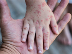 Dinkes Makassar Pastikan Tak Ada Warga yang Teridentifikasi Mpox/Cacar Monyet